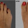 Silicone Hammer Toe Corrector